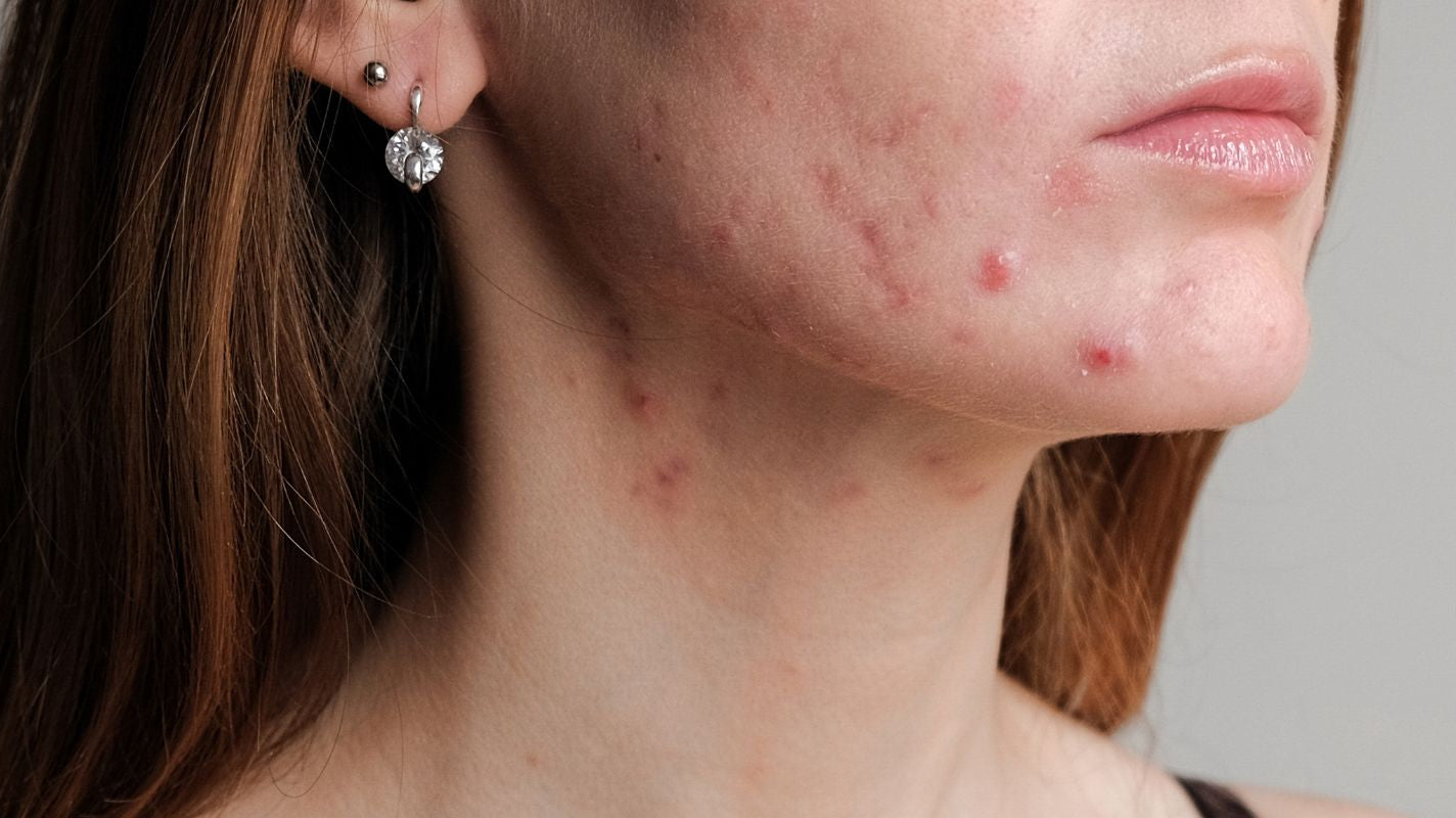 Malassezia Yeast: A Common But Often Overlooked Skin Disruptor