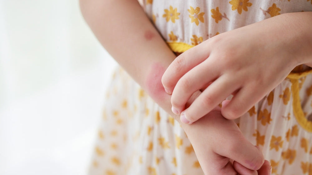Tips on Managing Eczema During the Summer