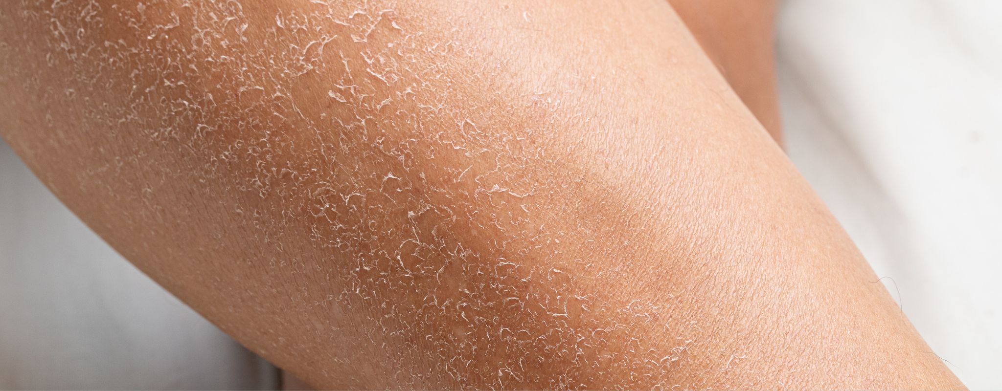 What Is Transepidermal Water Loss (TEWL)? How to Fix Dry, Sensitive Skin