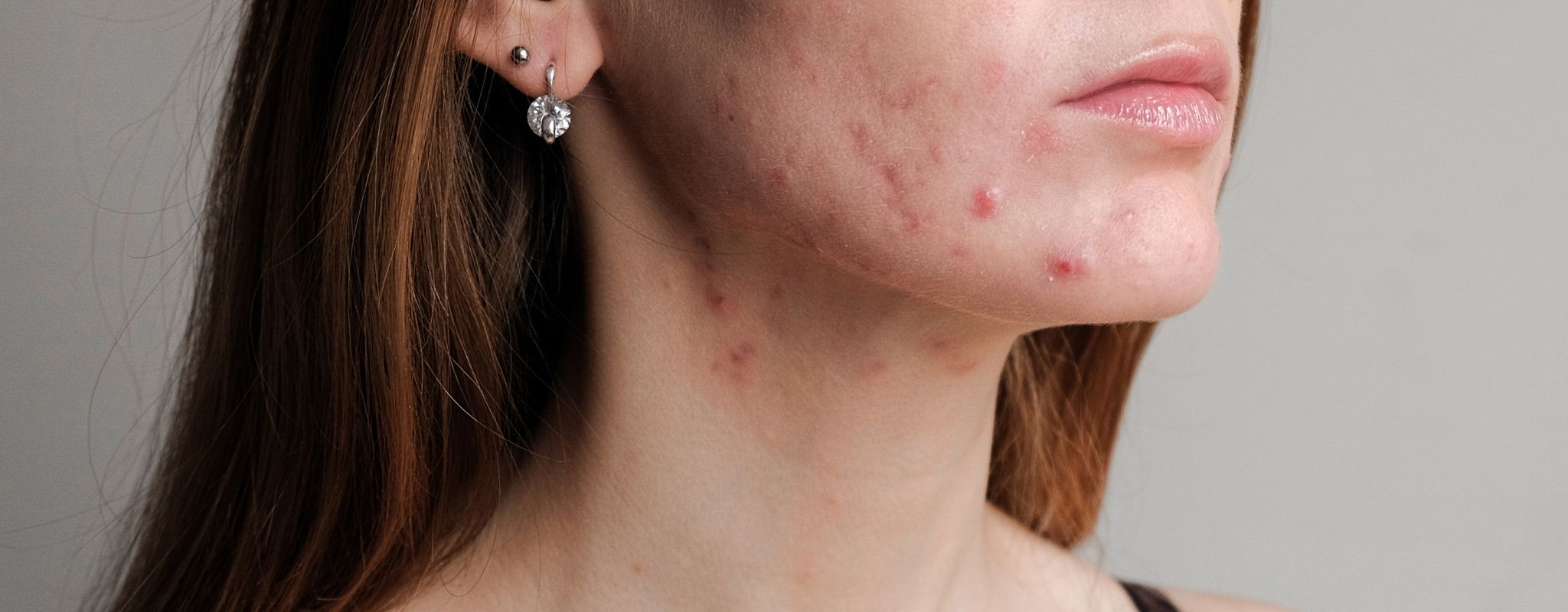 Malassezia Yeast: A Common But Often Overlooked Skin Disruptor