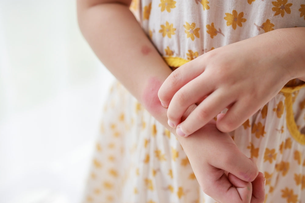 Tips on Managing Eczema During the Summer